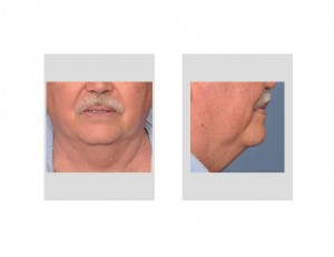 older-male-neck-fullness-wattle-dr-barry-eppley-indianapolis