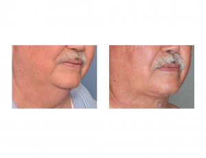 older-male-neck-liposuction-oblique-view-dr-barry-eppley-indianapolis