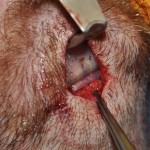 stacked-chin-implants-wafer-technique-dr-barry-eppley-indianapolis