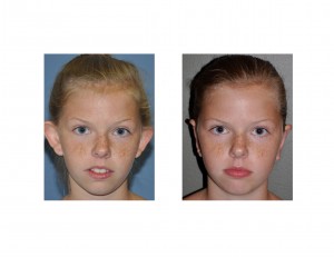 antihelical-fold-otoplasty-dr-barry-eppley-indianapolis