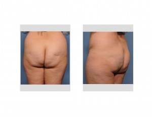 brazilian-butt-lift-before-surgery-dr-barry-eppley-indianapolis