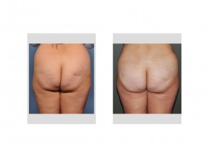 brazilian-butt-lift-results-back-view-dr-barry-eppley-indianapolis