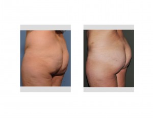 brazilian-butt-lift-results-left-oblique-view-dr-barry-eppley-indianapolis