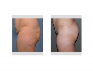 brazilian-butt-lift-results-side-view-dr-barry-eppley-indianapolis