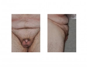 buried-penis-suprapubic-mound-dr-barry-eppley-indianapolis