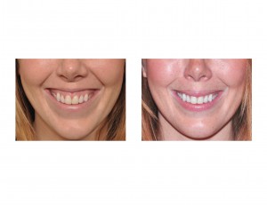 gummy-smile-correction-results-dr-barry-eppley-indianapolis