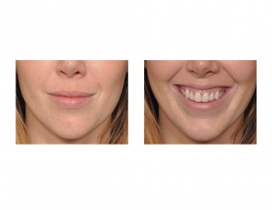 gummy-smile-problem-dr-barry-eppley-indianapolis