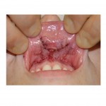 gummy-smile-surgery-dr-barry-eppley-indianapolis