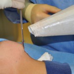 indianapolis-funnel-breast-augmentation-dr-barry-eppley2