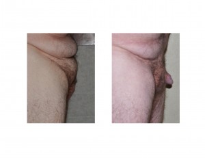 suprapubic-reduction-in-buried-penis-side-view-dr-barry-eppley-indianapolis