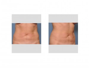 abdominal-liposculpture-before-dr-barry-eppley-indianapolis