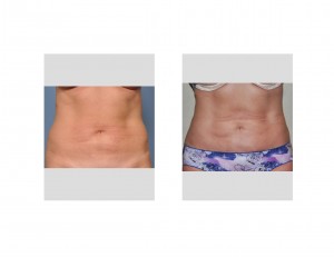 abdominal-liposculpture-result-front-dr-barry-eppley-indianapolis