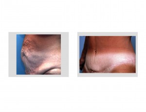 abdominoplasty-tummy-tuck-dr-barry-eppley-indianapolis