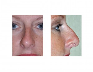 hooked-nose-dr-barry-eppley-indianapolis