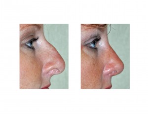 hooked-nose-rhinoplasty-dr-barry-eppley-indianapolis-side-view