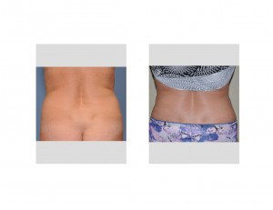 liposculpture-result-flanks-dr-barry-eppley-indianapolis