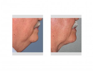 smartlipo-of-neck-older-patient-dr-barry-eppley-indianapolis
