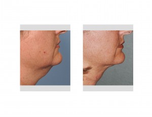 smartlipo-of-neck-younger-patient-dr-barry-eppley-indianapolis
