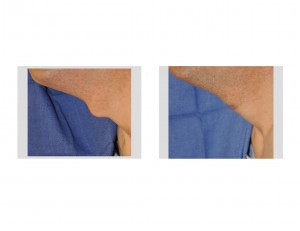 tracheal-reduction-intraoperative-view-dr-barry-eppley-indianapolis