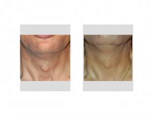 tracheal-reduction-result-front-view-dr-barry-eppley-indianapolis