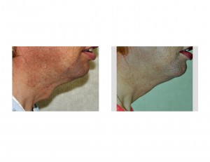 tracheal-reduction-result-side-view-dr-barry-eppley-indianapolis