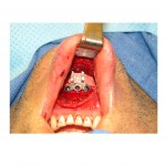 vertical-chin-lengthening-osteotomy-dr-barry-eppley-indianapolis