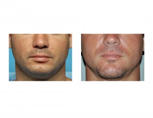 vertical-chin-lengthening-result-front-view-dr-barry-eppley-indianapolis
