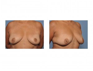 breast-augmentation-in-older-women-before-dr-barry-eppley-indianapolis