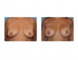breast-augmentation-in-older-women-results-front-view-dr-barry-eppley-indianapolis