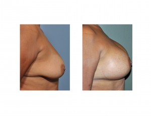 breast-augmentation-in-older-women-results-side-view-dr-barry-eppley-indianapolis
