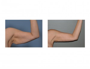 armlift-results-left-side-dr-barry-eppley-indianapolis