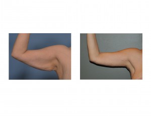 armlift-results-right-side-dr-barry-eppley-indianapolis