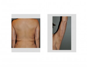 armlift-scars-dr-barry-eppley-indianapolis
