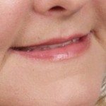 corner-of-mouth-lift-long-term-result-dr-barry-eppley-indianapolis