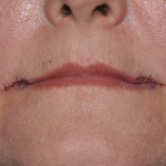 corner-of-the-mouth-lift-immediate-result-dr-barry-eppley-indianapolis