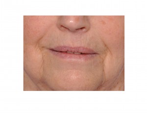 deep-aging-nasolabial-folds-dr-barry-eppley-indianapolis