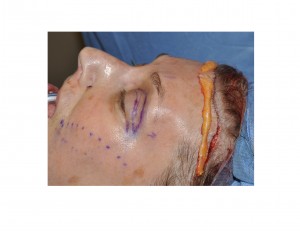 dermal-fat-graft-harvest-from-browlift-dr-barry-eppley-indianapolis