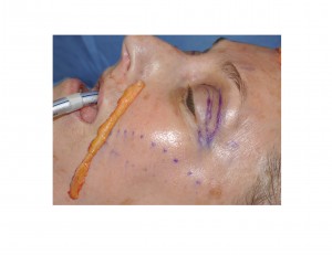 dermal-fat-graft-to-nasobial-folds-dr-barry-eplpey-indianapolis