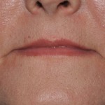downturned-corners-of-the-mouth-dr-barry-eppley-indianapolis1