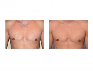 gynecomastia-reduction-in-athletes-dr-barry-eppley-indianapolis