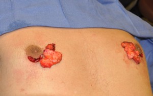 gynecomastia-reduction-tissue-dr-barry-eppley-indianapolis2