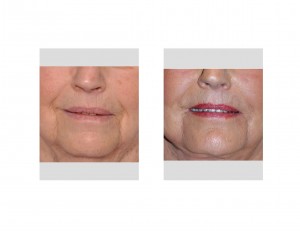 nasolabial-fold-reduction-with-dermal-fat-grafts-dr-barry-eppley