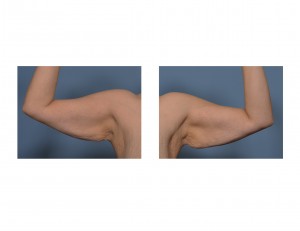 saggy-arms-after-bariatric-surgery-dr-barry-eppley-indianapolis