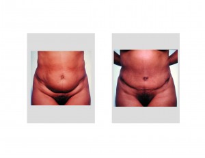 tummy-tuck-surgery-abdominal-reshaping-indianapolis-dr-barry-eppley