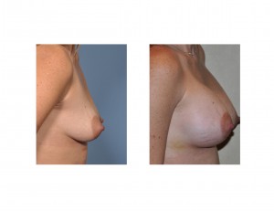 breast-augmentation-medium-size-dr-barry-eppley-indianapolis