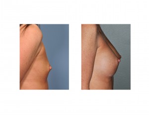 breast-augmentation-small-size-dr-barry-eppley-indianapolis