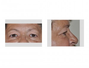 eye-aging-and-vision-obstruction-dr-barry-eppley-indianapolis