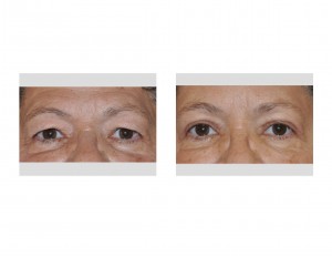 upper-blepharoplasty-and-browlift-results-dr-barry-eppley-indianapolis-front-view