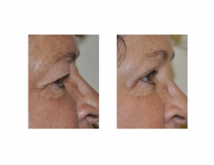 upper-blepharoplasty-and-browlift-results-dr-barry-eppley-side-view
