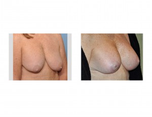 breast-lifts-and-implant-exchange-dr-barry-eppley-indianapolis-oblique-view